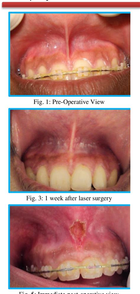 Figure 3 From Maxillary Labial Frenectomy Using Diode Laser Report Of Two Cases Semantic Scholar