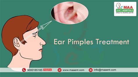 How To Clear Pimples In Ears