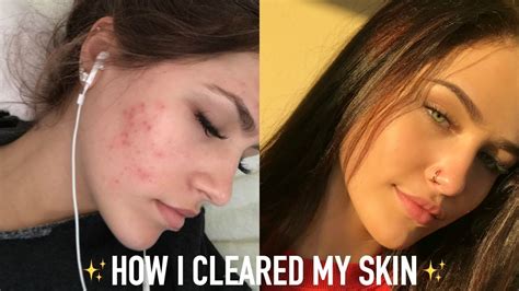My Skincare Routine How I Cleared My Acne Mel Joy Youtube