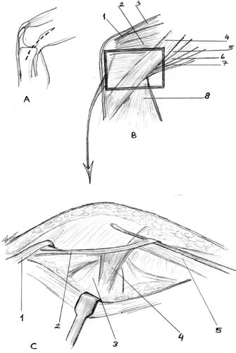 Full Article The Fascial Band From Semitendinosus To Gastrocnemius