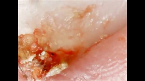 What causes infections in ingrown toenails? Removing Skin and Infection from an Ingrown Nail. An ...
