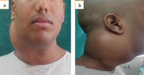 Aandb Clinical Picture Showing Front And Side View Of The Neck Swelling