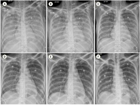 Chest Radiographs Obtained On Hospital Days 4 To 9 A 4 B 5 C