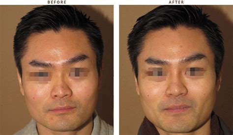 Rhinoplasty chicago rhinoplasty as it is known by its medical term as nasal surgery or its popular term nose job, is a procedure performed to restore either form or functionality to the nose. Non-surgical nose job Chicago * | Dr Turowski - Plastic ...