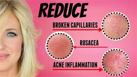 Reduce Facial Redness Broken Capillaries Rosacea And Acne Inflammation