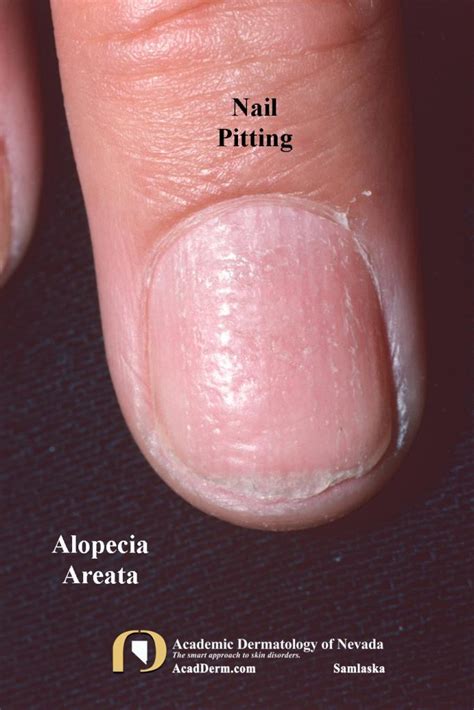 Top 117 Alopecia And Nail Dystrophy Treatment Latest Vn