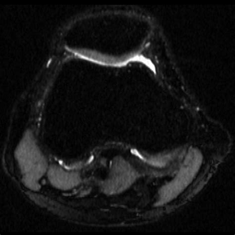 Isotropic Mri Of The Knee With 3d Fast Spin Echo Extended Echo Train