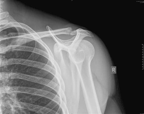 Distal Clavicle Osteolysis Injuries And Rehab Community T Nation