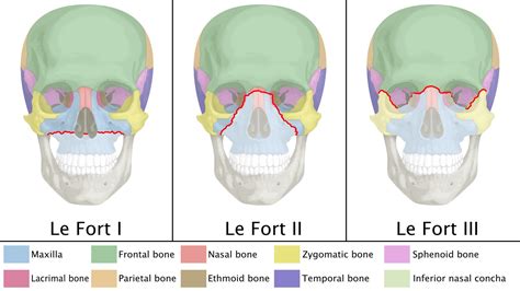 Simple Skull Fracture