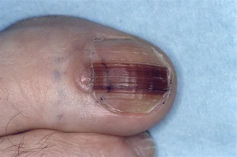 Early Identification Of Nail Unit Melanoma Leads To Good Prognosis