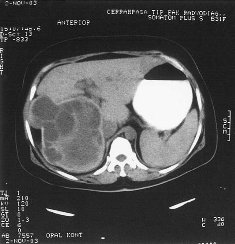 Compute Tomographic Appearance Of An Hepatic Cyst With Significant