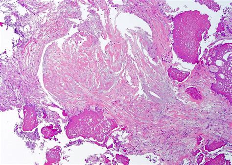 Pathology Outlines Eosinophilic Cystitis