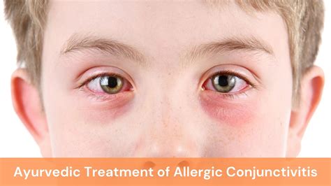 Allergic Conjunctivitis Causes Symptoms And Ayurvedic Treatment