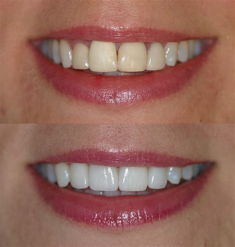 Before And After Porcelain Veneers Cosmetic Dentists Of Houston