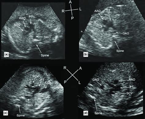 Transverse Sections Of The Upper Fetal Thorax In Caudal To Cranial