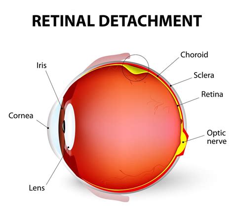 Know Early Warning Signs Of Retinal Detachment Elman Retina Group