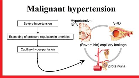 Malignant Hypertension Youtube