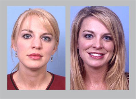 We did not find results for: Nose Deformities | Dr. William E. Silver | Atlanta GA ...