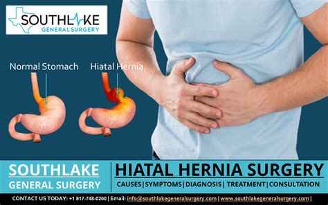 Hiatal Hernia Surgery At Southlake General Surgery Texas