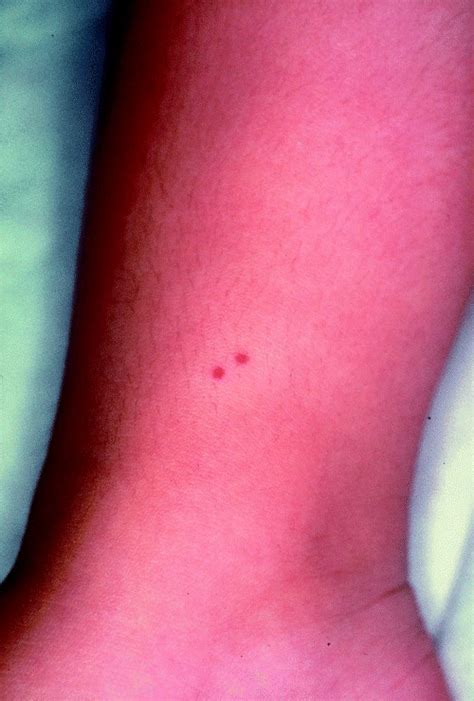 Two Small Bright Red Papules Surrounded By A Halo Of Blanching Are