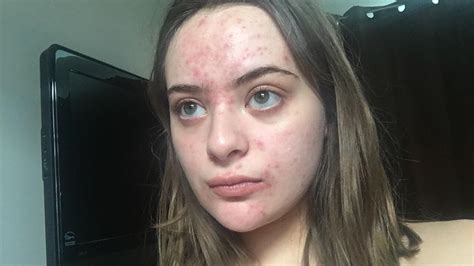 Very Sudden Massive Breakout All Over Face General Acne Discussion