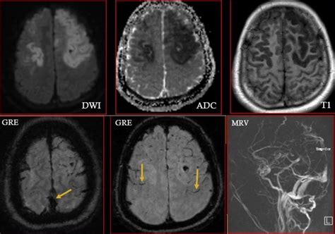 15 Years Old With Superior Sagittal Sinus Thrombosis Acute Venous Download Scientific Diagram