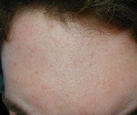 Small Bumps On Face Not Acne White Bumps On Face Small Bumps On Face