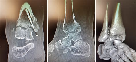 Artrodesi caviglia chiodo retrogrado: quando è indicata