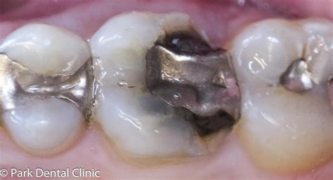 Chipped Tooth Repair Molar
