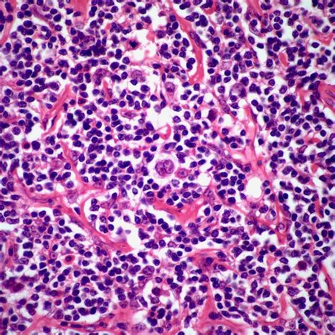 Enlarged Lymph Node In 20 Year Old Patient Cancer Network