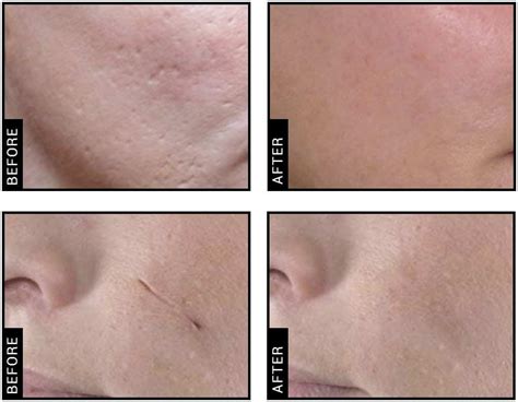 Scar Removal And Hypertrophic Scar Treatment Sw3 London 23md
