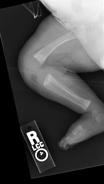 Rickets Other Imaging Findings Wikidoc