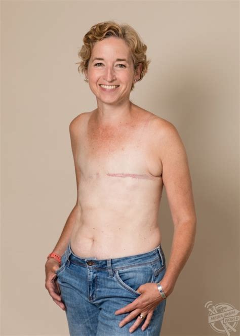 This Courageous Mother Has Posed Topless After Undergoing A Mastectomy My Xxx Hot Girl