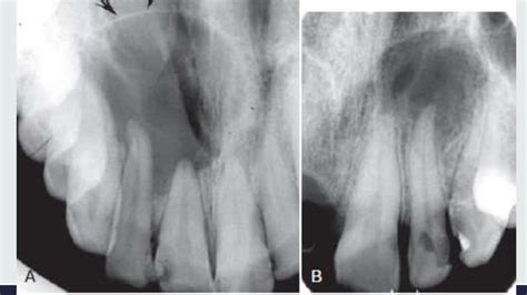 Radiographic Interpretation Of Cyst And Cyst Like Lesions Of The Jaws