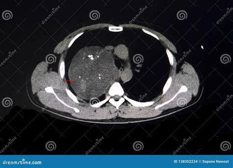 Ct Scan Of A Chest Showing Anterior Mediastinal Tumor Stock Photo