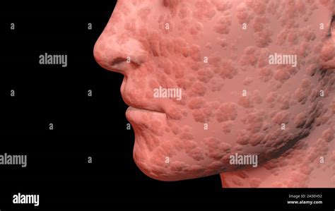 Skin Problems Red Bumpy Infected Skin On Face 3d Rendering Stock