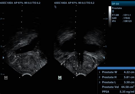 Transrectal Ultrasound And Prostate Biopsy Trus Biopsy Urology