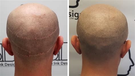 What Does A Hair Transplant Scar Look Like Maxim Hair Restoration 2022