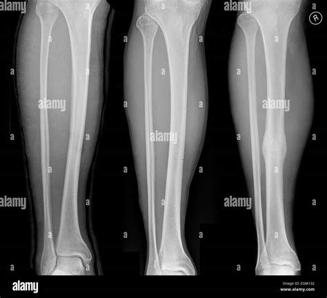 Sequence Showing An Uncomplicated Fracture Of Tibia Showing Left To