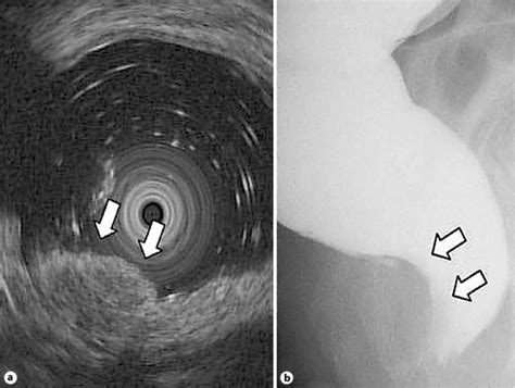 A Endoscopic Ultrasonography Showed A Hypoechoic Mass At The Second And