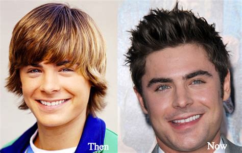 Zac Efron Plastic Surgery Before And After Photos