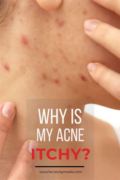 Can Acne Be Itchy Heres Why