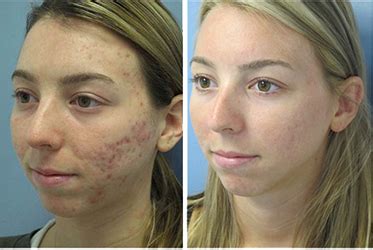 Acne Treatment Clear Clinic