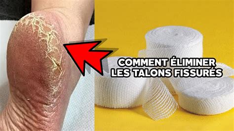 Éliminez Les Talons Fissurés Les Cors Et Les Callosités Grâce à Ce