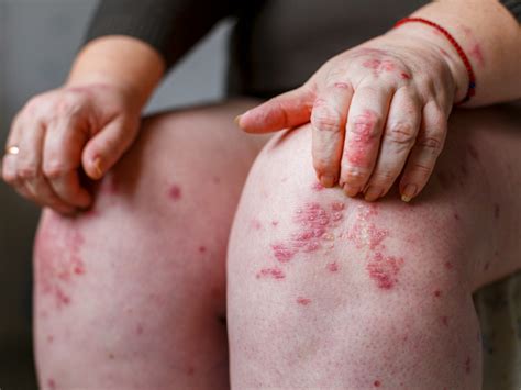 Psoriasis Rash Pictures Causes Symptoms And Treatment