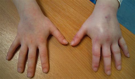 New Onset Unilateral Arm Swelling In A Child With Periorbital Oedema