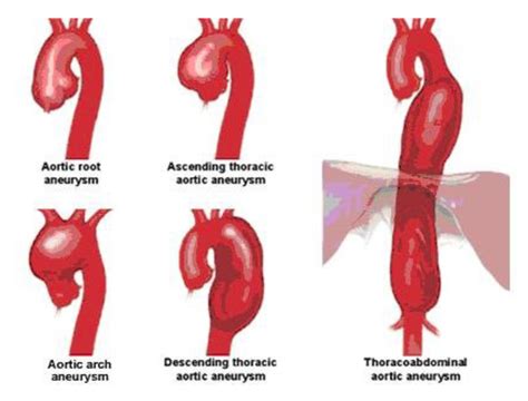 Aortic Aneurysm And Dissection Repair Patient Care