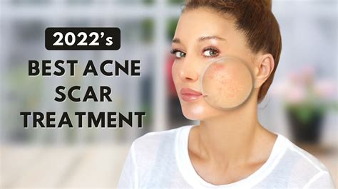 2022s Best Acne Scar Treatment