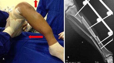 A Patient Presenting Segmental Fracture Observe Leg Deformity When The