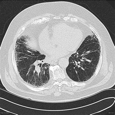 Interstitial Lung Disease Ild Usual Interstitial Lung Disease Uip